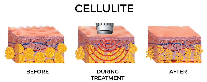 Beauty Acoustic Wave Therapy For Cellulite 4rd Gen Magnetic Electric Source