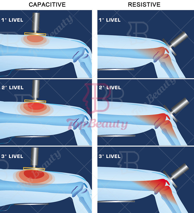 CET RET Tecar Therapy Machine Skin Rejuvenation Sport Injury Recovery