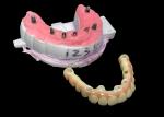 Implant supported Full Arch Denture Fixed Dental implant Ceramic Crown Bridge