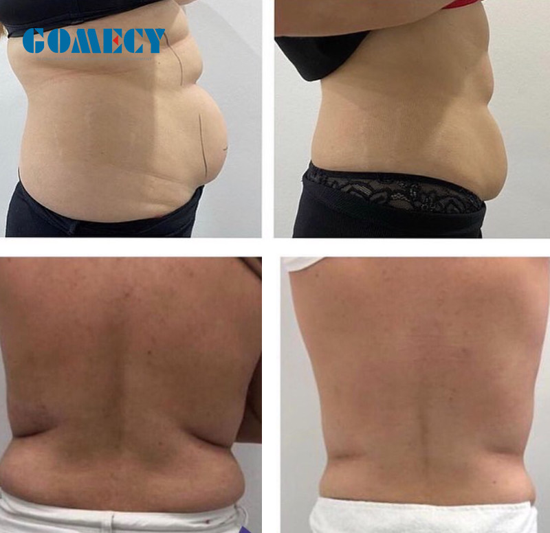 Beauty Salon Lipo Laser Slimming Machine 0.1-5s Pulse Time OEM ODM Services