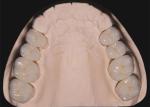 Dental Restoration Teeth Zirconia dental Crowns crafted by china dental lab