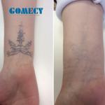 Tattoo Removal Picosecond Laser Machine Q Switched Nd Ydg 755nm 1064nm