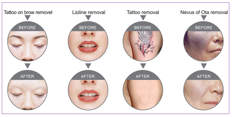 Portable Q - Switched Tattoo Laser Removal Equipment With Adjustable Treatment Probes