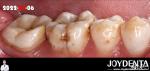 Natural Color Accurate Fit Dental Inlay For Damaged Teeth Restoration