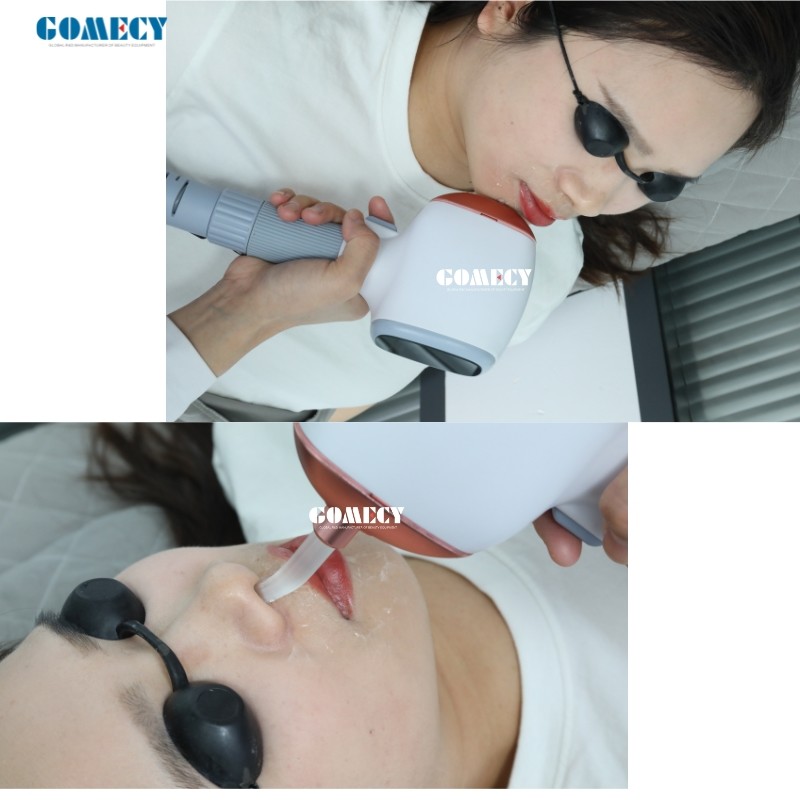 755 808 1064nm OEM Diode Laser Hair Removal Device for Ozero Khanka Pioneer