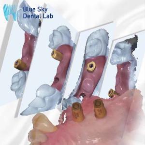 Wholesale Scan Body All In One Dental Healing Capsule Blue Sky Implant System from china suppliers