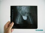 28cm * 35cm Medical Film Xray Paper For KND-DRYTEC-3000 Laser Printer