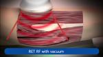 448khz Tecar Rehabilitation Machine Vacuum Cet Ret RF Monopolar Spa Clinic