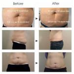 Super product standing cool slimming cellulite reduction cool tech fat freezing