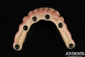 Wholesale Durable Dental Aesthetic Titanium Malong Hybrid Bridge For Care from china suppliers