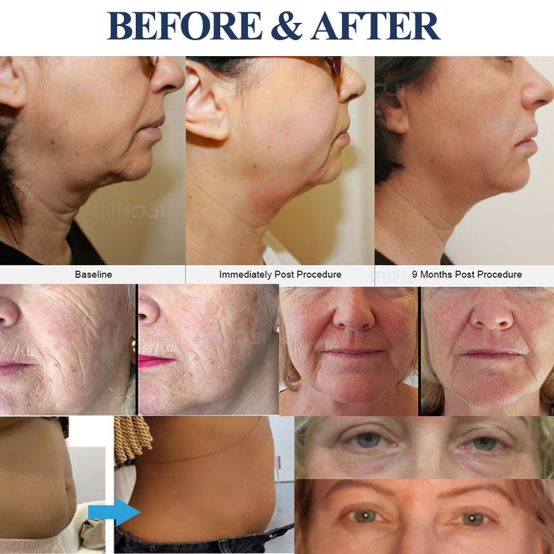 Professional Hifu Beauty Machine 12D Anti Aging Ultrasonic Facial beauty