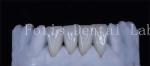Polishing Finishing Cosmetic Teeth Veneer Covers For Beautiful Smile