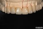 CAD / CAM Milling Dental Layered Zirconia For Single Crowns 0.3-0.5mm Layer