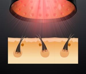 Wholesale ABS 81 Diodes Laser Hair Loss Treatment HairPro Laser Therapy Cap from china suppliers