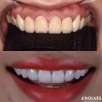 CAD/CAM Compatible Zirconia Dental Crowns Precision Manufacturing For Tailored