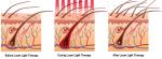 Laser hair regrowth Low Level Laser Hair Restoration Lamp Laser hair care hair