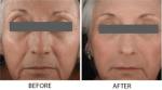 Fractional Laser Skin Resurfacing Machine , CO2 Viginal Skin Rejuvenation