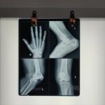 Low Fog Level Medical X Ray Blue Film 200±5μM High Sharpness