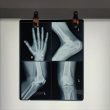 Low Fog Level Medical X Ray Blue Film 200±5μM High Sharpness