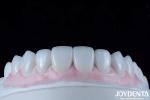 Long Lasting Dental Composite Veneer Good Biocompatibility No Drop Off porcelain