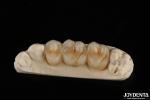 Wear Resistant Zirconia Full Contour Dental Crown High Translucency