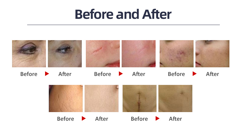 Small Desktop Portable Fractional Co2 Laser For Scar Stretch Mark Removal