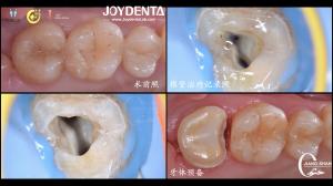 Wholesale Long Lasting Natural Looking dental ceramic inlay Precise Fit High Compatibility from china suppliers