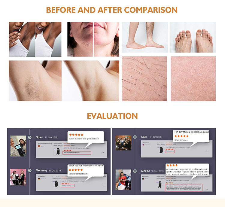 Stationary Anybeauty SFDA 808nm Diode Laser Hair Removal Machine