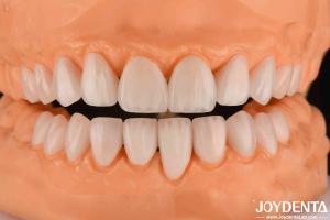 Wholesale Ceramic Emax Veneers 0.3-0.5mm Thickness Long Lasting Cosmetic Porcelain Veneers from china suppliers