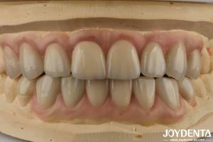 Wholesale High Translucency Emax Cosmetic Dentistry Veneers High Aesthetics Ultra Thin from china suppliers
