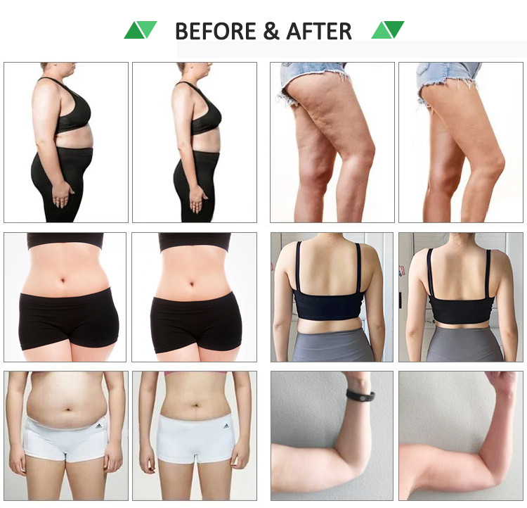 Non Surgical BBL Machine , AB Sculpting Machine With 10D Laser Tech