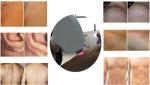 2015 Top seller!Painless portable 808 nm diode laser hair removal machine best