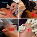 1470nm Face Lifting Lipolysis Laser Liposuction Machine Laser Fat Removal Endo
