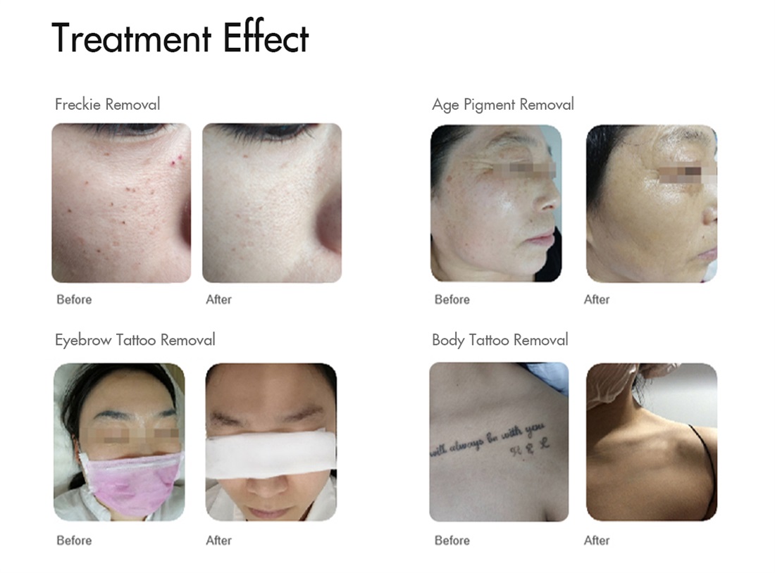 Q Switched Nd Yag Laser Tattoo Removal Picolaser Carbon Laser Peel Machine Q switch Laser Tattoo Removal machine