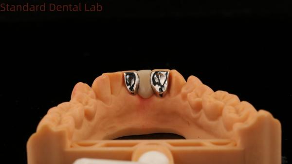 Dental PFM Maryland Bridge High Esthetics FDA Certified With Vita Porcelian
