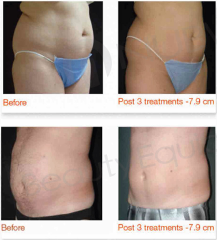 Hot promotion!!! HIFU body slimming vacuum slim equipment&machine