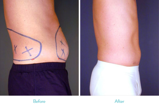 Aesthetic Surgical Liposuction Machine For Abdomen / Upper Arm Surgical Suction Slimming Machine