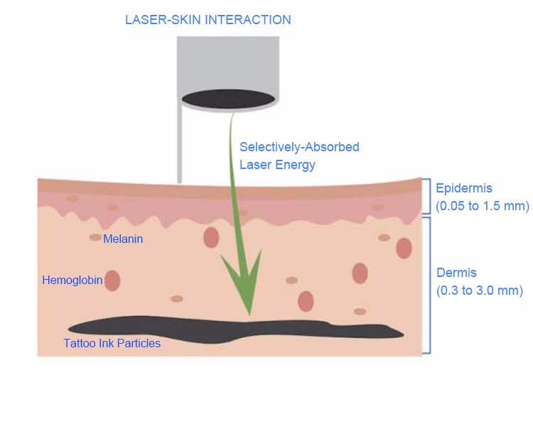 The Best Q Switched ND Yag Laser Made In China with Big Promotion
