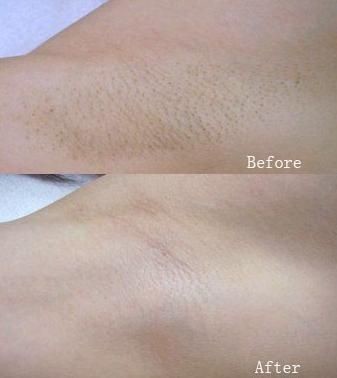 IPL SHR Elos Hair Removal System Strong Pulse Multi Wavelength With Cooling
