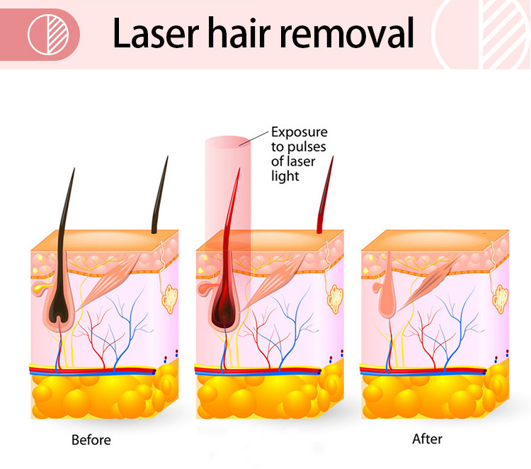 Portable 808nm Diode Laser Hair Removal Machine With 8 Inch Color Touch Screen