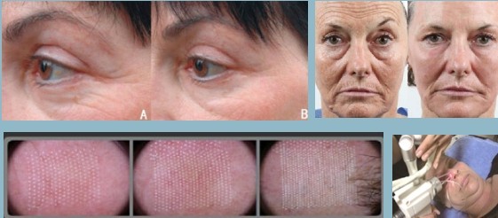 RF CO2 Fractional Skin Rejuvenation and Vaginal Tightening Laser Machine