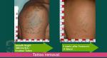 Picosecond Laser Facial Rejuvenation Machine , Q Switched Tattoo Removal Machine