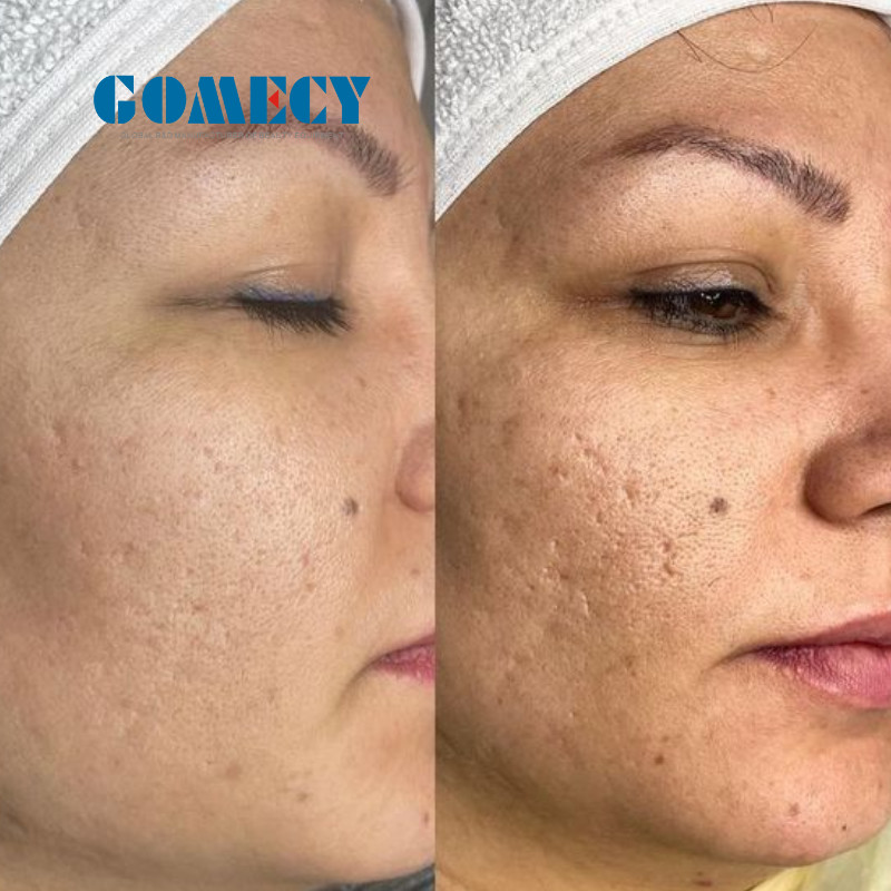 Professional Microneedle RF Machine with Adjustable Depth for Skin Rejuvenation and Scars Removal