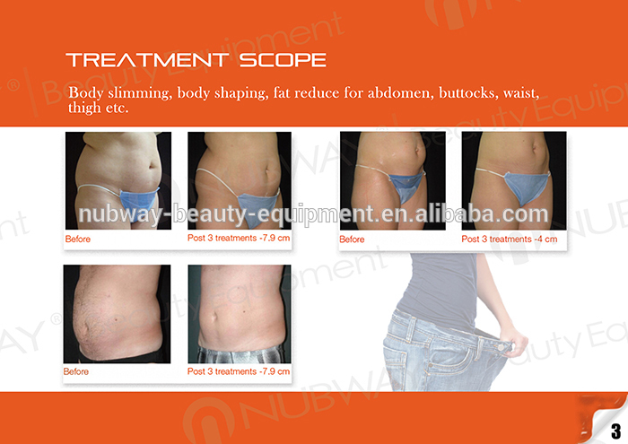 HIFU Body Fat Slimming! Newest Ultrashape Machine High Intensity Focused Ultrasound HIFU