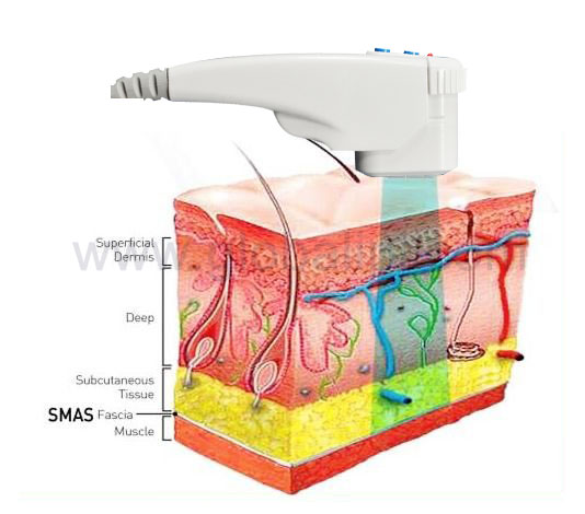 Non Surgical Body Liposonix Fat Reduction Hifu Machine For Body Slimming