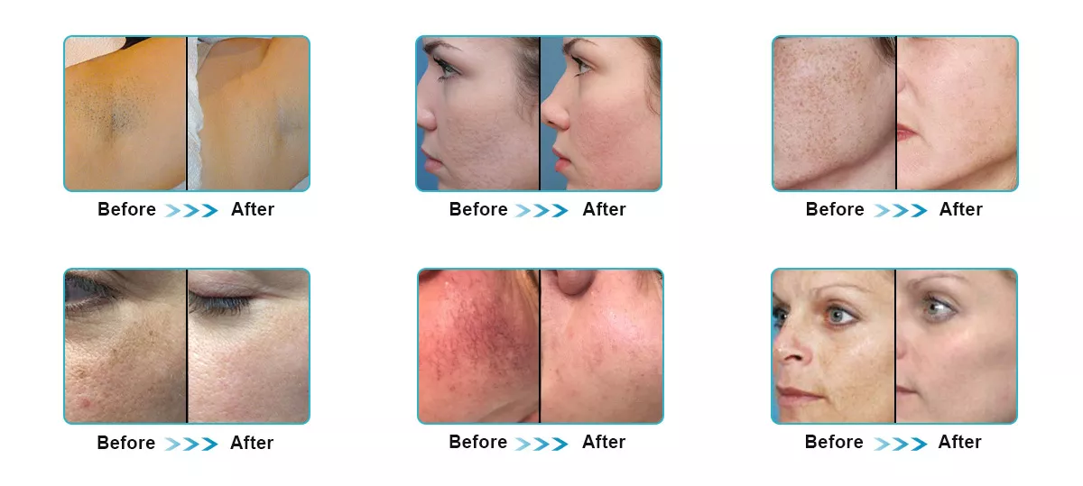 Effective Type 3 In 1 E-Light Opt Shr Ipl Laser Hair Removal Shr Ipl Skin Rejuvenation Machine