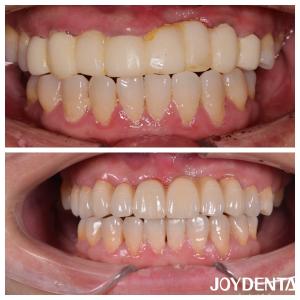 Wholesale Natural Color Multilayer Dental Zirconia Bridges For Optimal Patient Experience from china suppliers