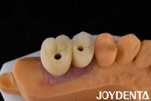 Wholesale Porcelain Implant Crown and Bridge The Ultimate Solution for Restoration Of Missing Teeth from china suppliers