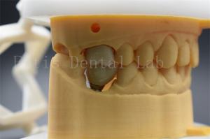 Wholesale Customizable Dental Implant Abutment Crown Comfortable For Patients from china suppliers