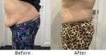 Coolwaves Body Forming Belly Fat Burn Weight Loss Slimming Beauty Machines New